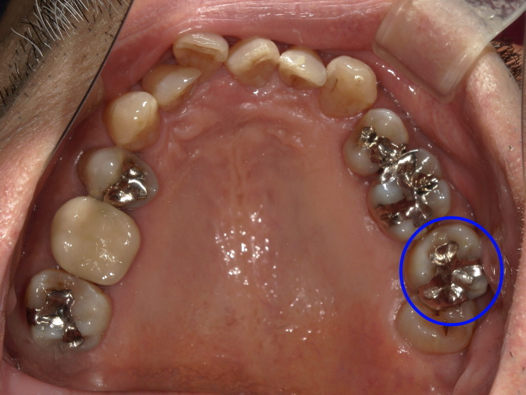 金合金(PGA)治療2