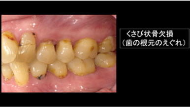 咬合性外傷が現れているサインとして