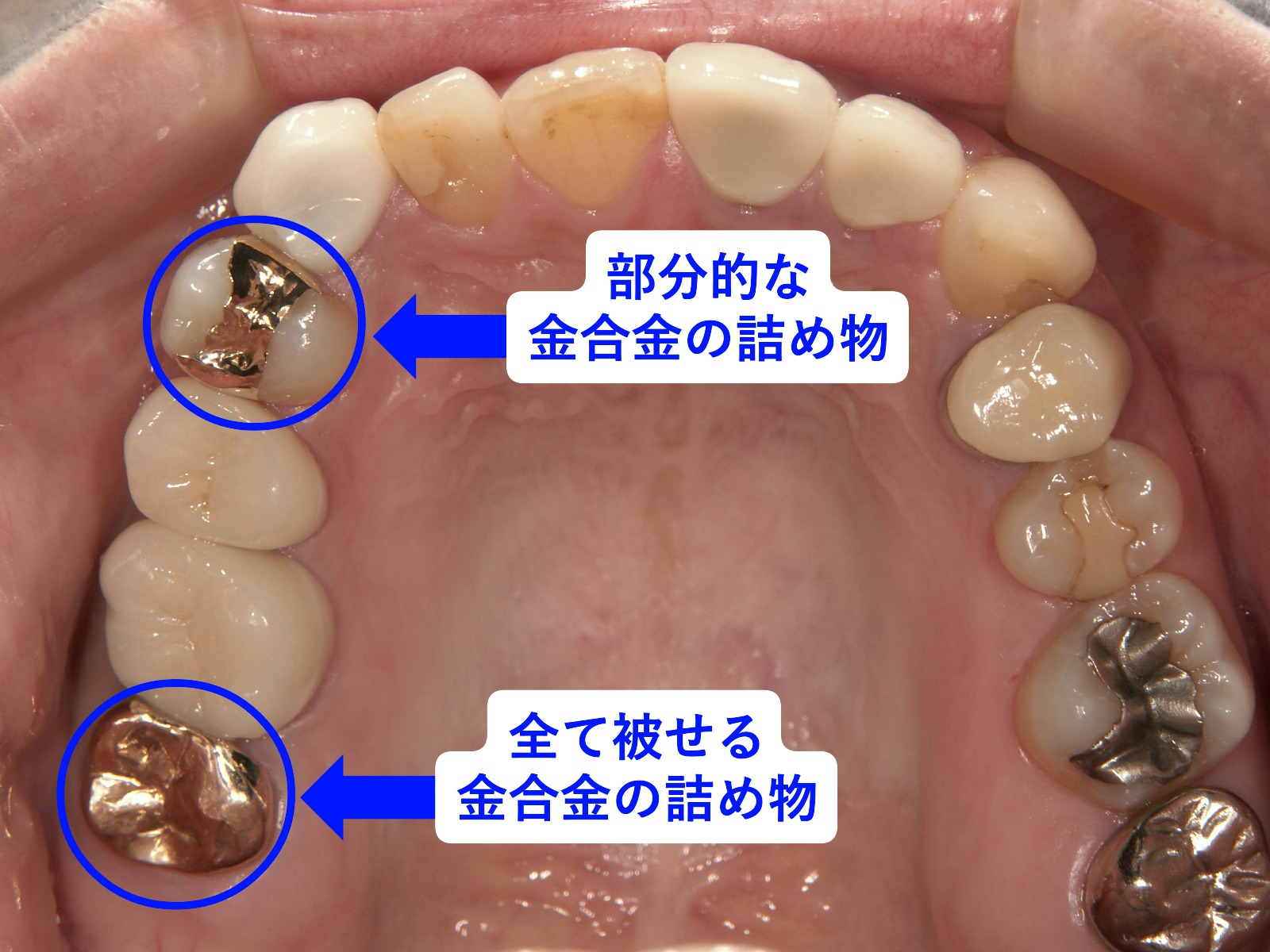 治療から15年後