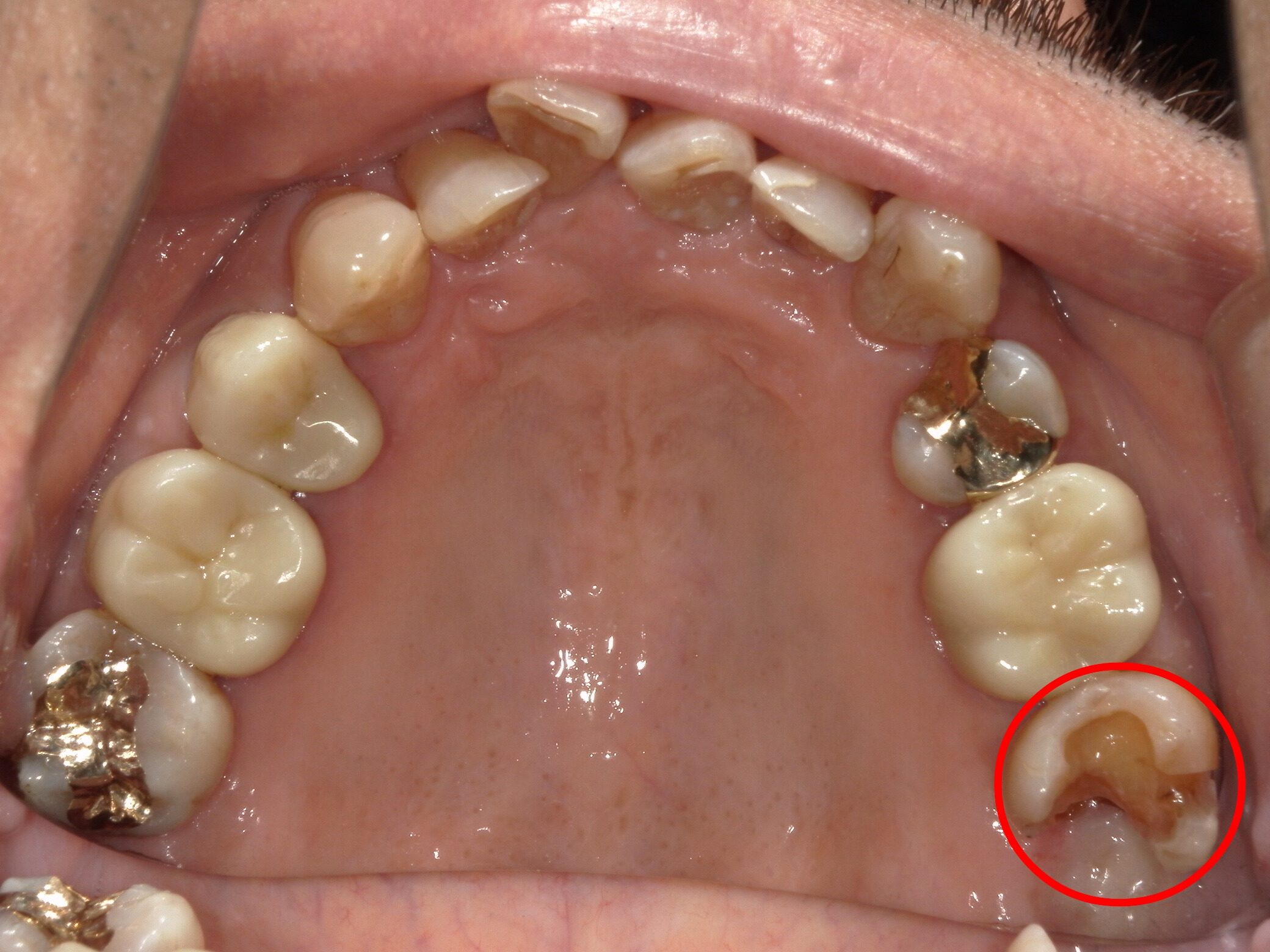 金合金(PGA)治療2