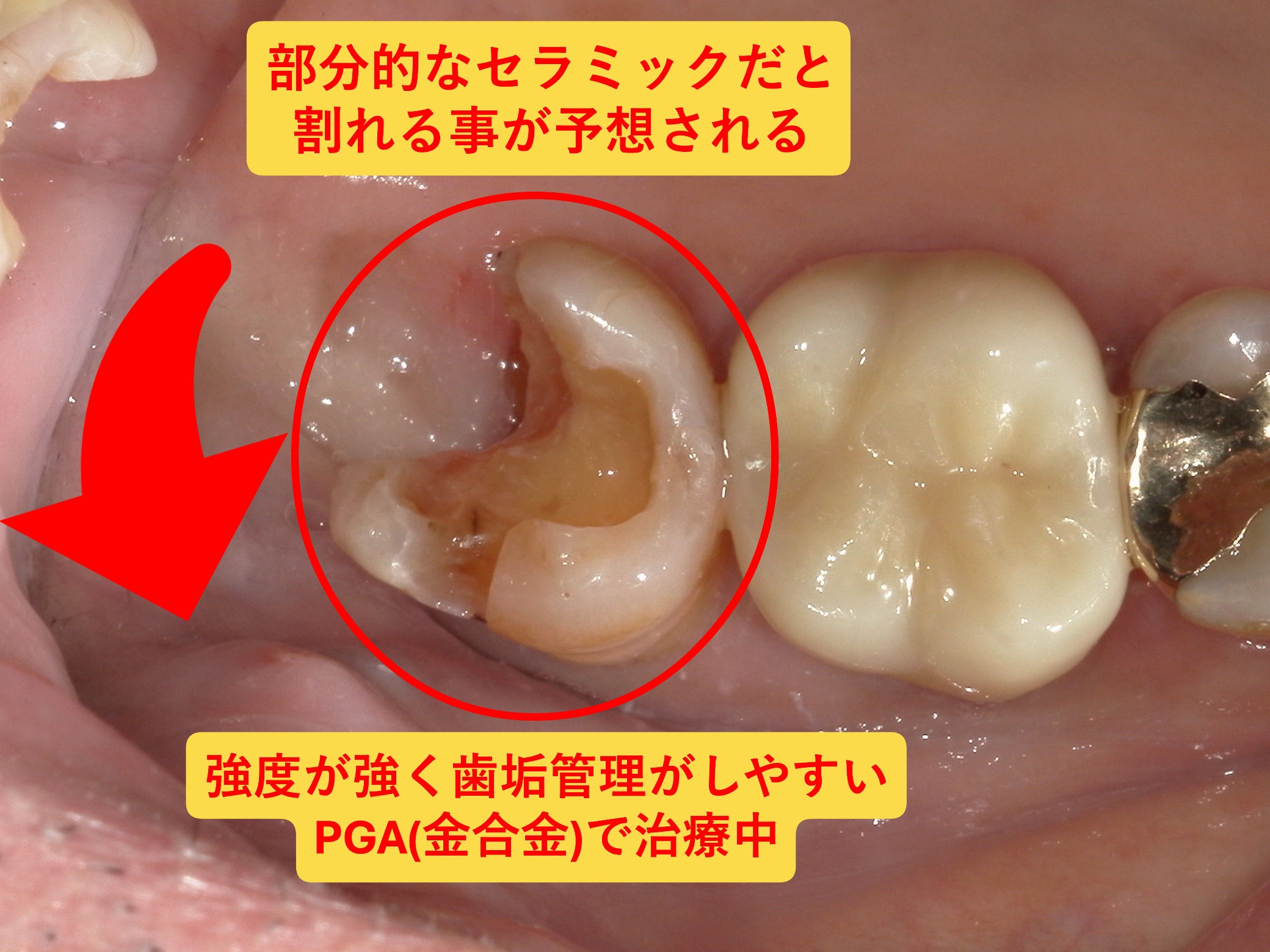 金合金(PGA)治療2