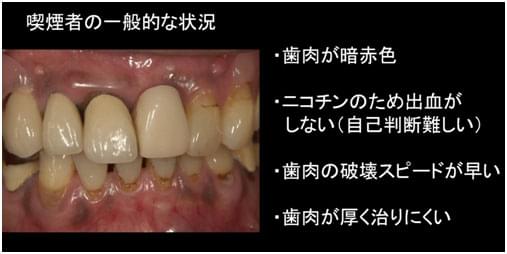 えっ、タバコで歯が抜ける？