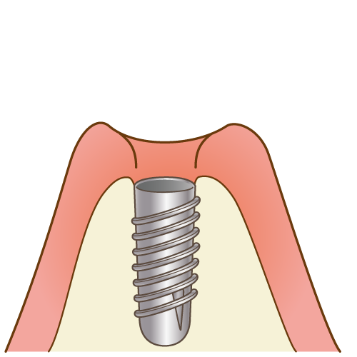 インプラント手術