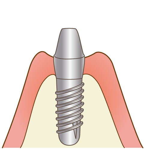 インプラント二次手術