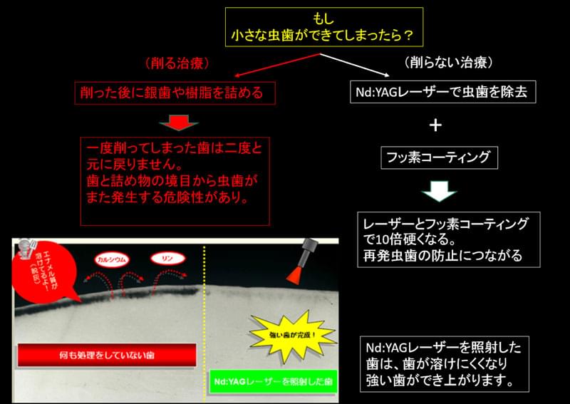 歯周病だけでなく虫歯にも使えるレーザー