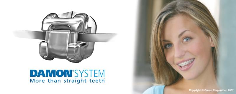 当院のご用意している矯正装置『デーモンシステム』について