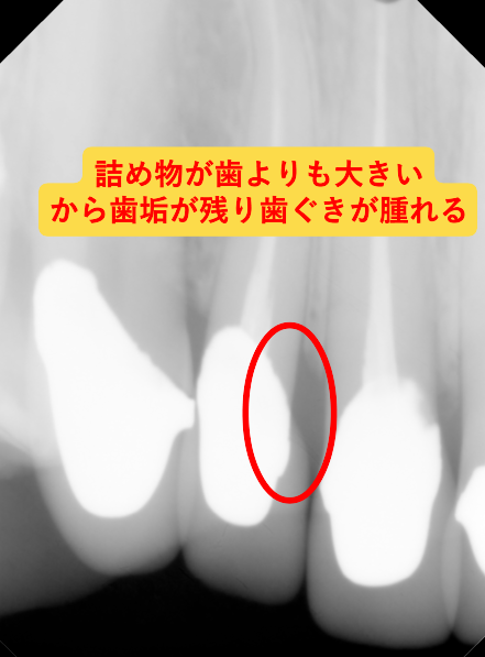 セラミックと歯周病