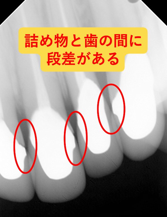 セラミックと歯周病