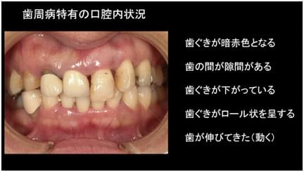歯周病について