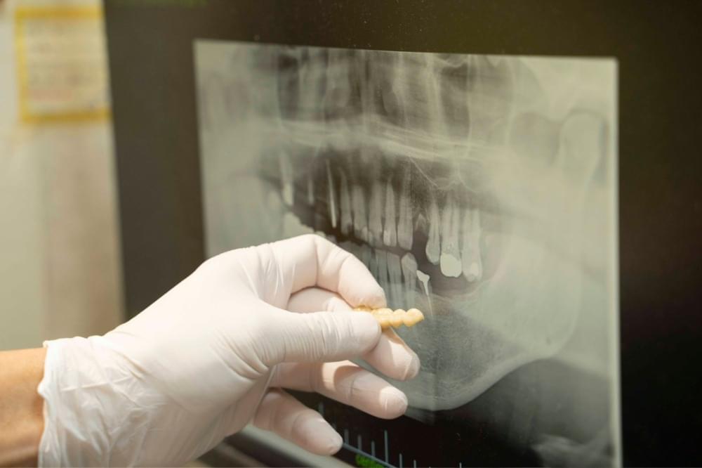 補綴(詰め物・被せ物)