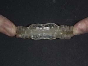 マウスピース療法（スリープスプリント）