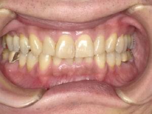 マウスピース装着前