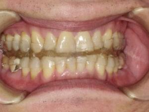 マウスピース装着後